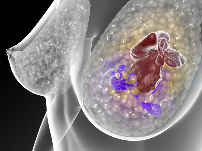 Câncer de mama triplo-negativo é a forma mais agressiva de câncer de mama e o único tipo de tumor de mama que ainda não tem uma terapia-alvo; estudo demonstram que um inibidor de JAK2 como uma possível terapia específica (Foto: C. Bickel/Science Translational Medicine) 