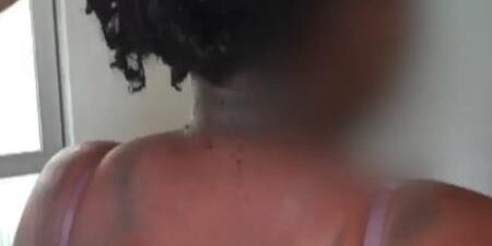 ataque-deixou-queimaduras-de-2-e-3-grau-na-vitima-1566414263715_v2_450x600